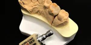 CAD/CAMインレーが保険適用になりました